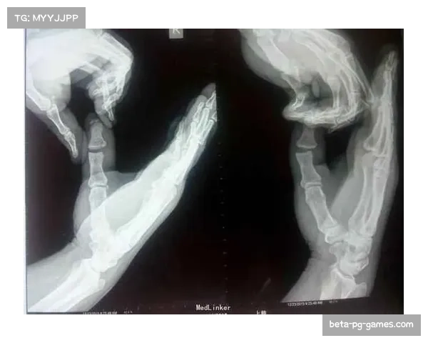 塞布尔因拇指韧带撕裂需休养，四至六周后复查决定回归时间